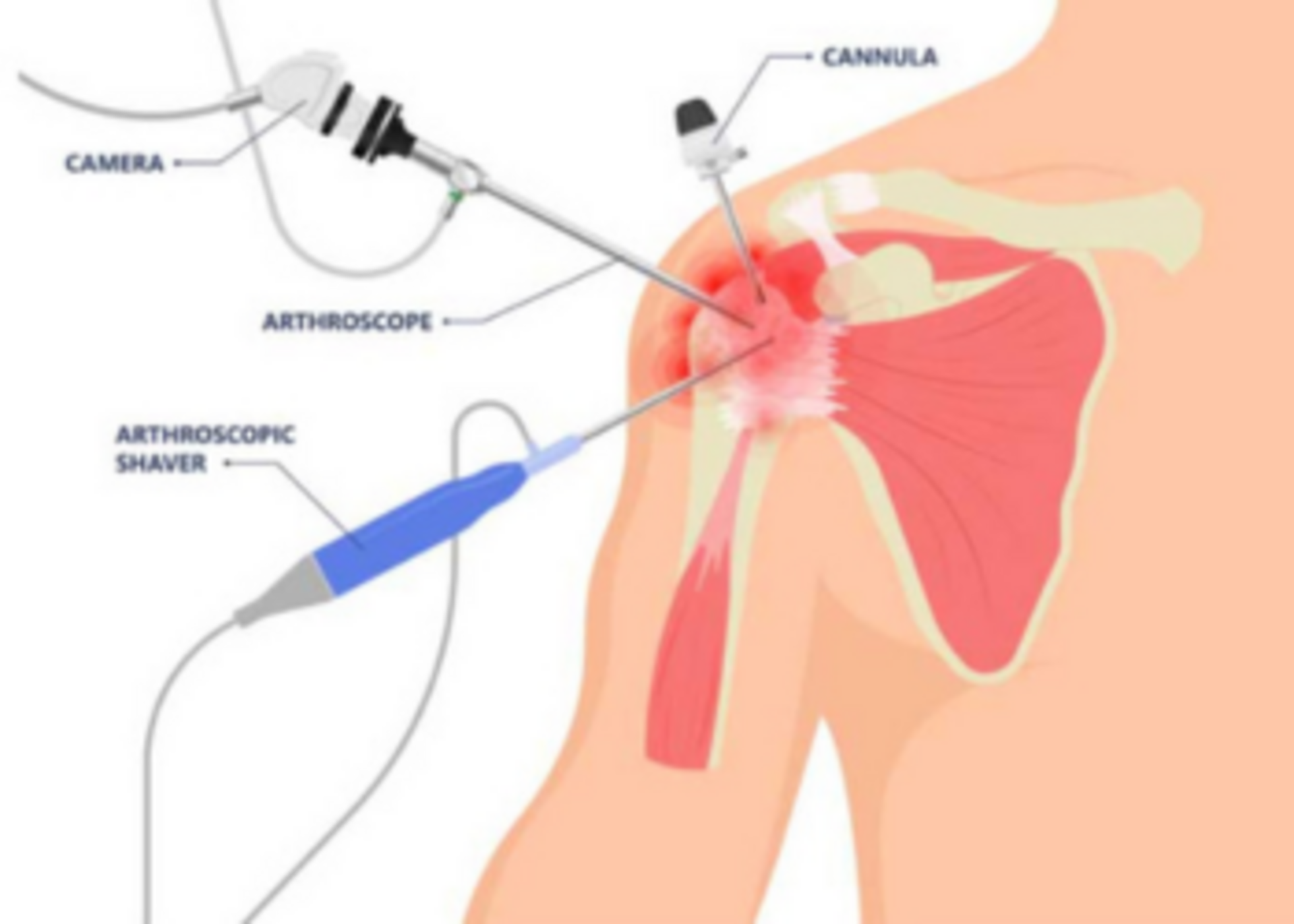 shoulder Arthroscopy
