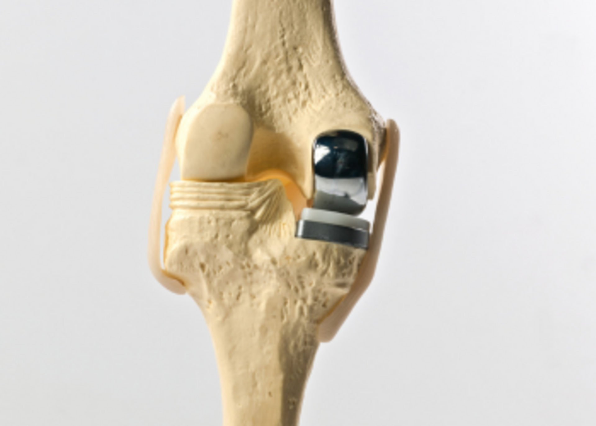 Unicondylar Knee Repacement