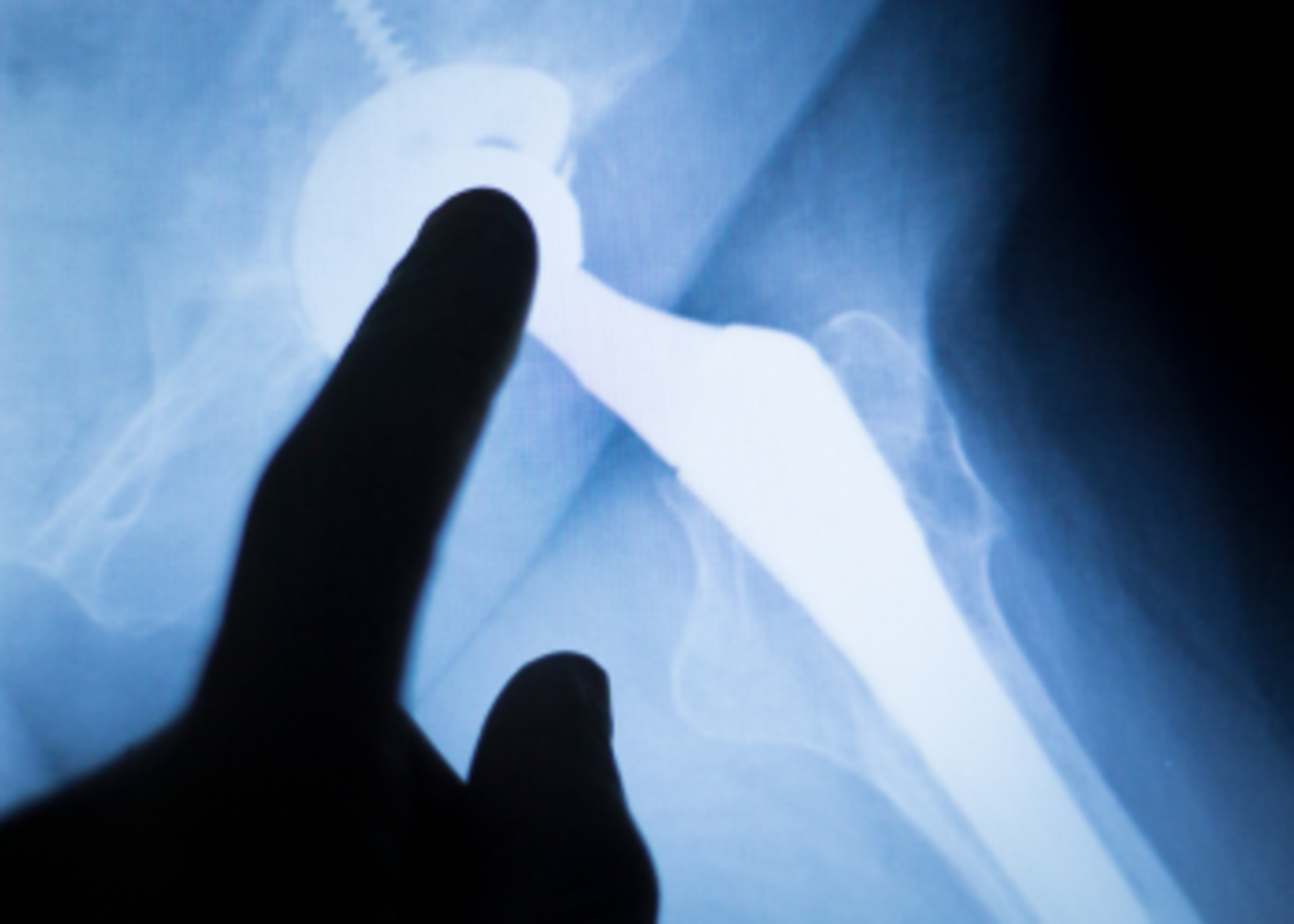 Revision Joint Replacement