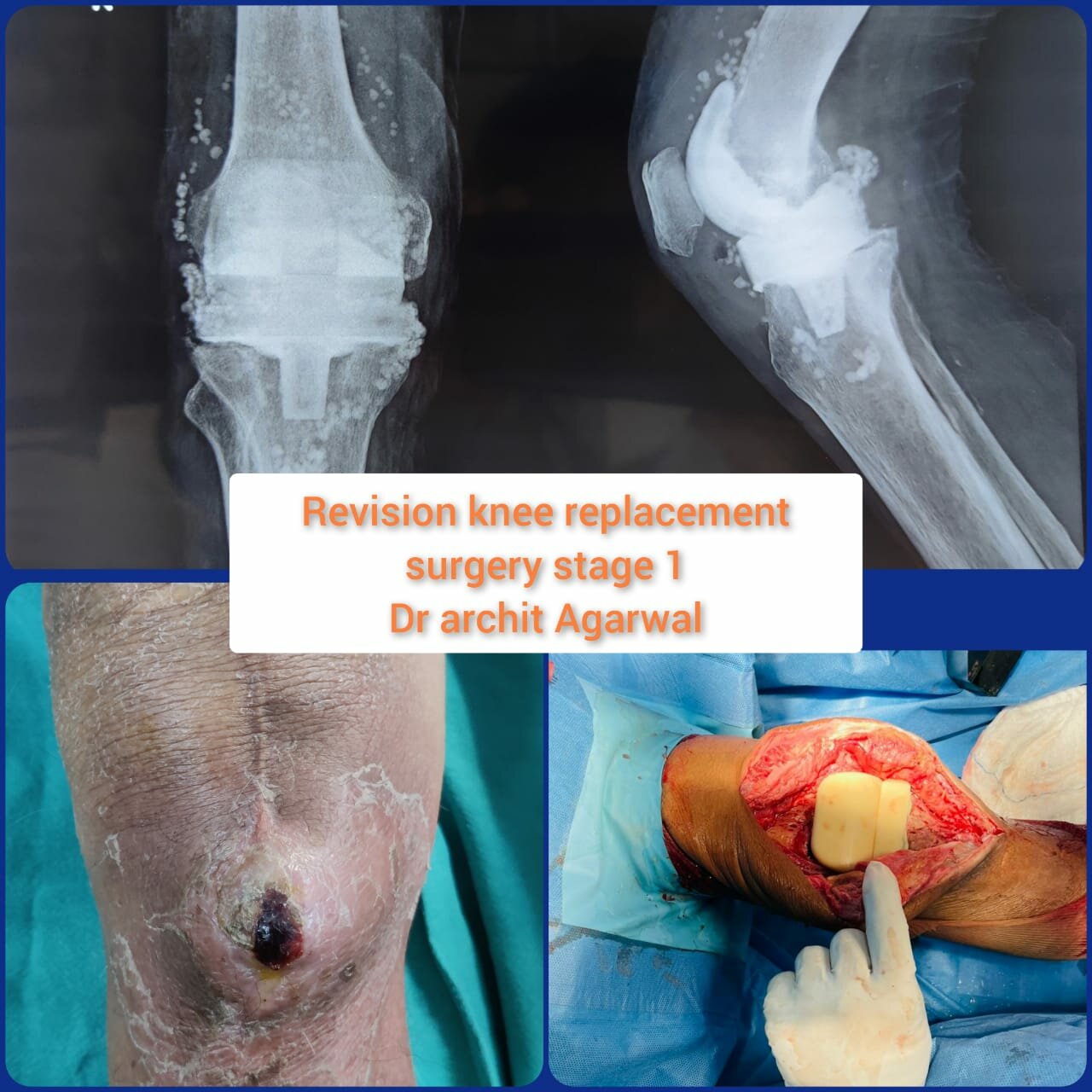 Complex Knee Revision Surgery Performed by Dr. Archit Agarwal|Dr Archit Agarwal|Dehradun,Dehradun